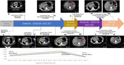 Case Report: Afatinib Sensitivity in Rare EGFR E746_L747delinsIP Mutated LUAD With Peritoneal Metastases